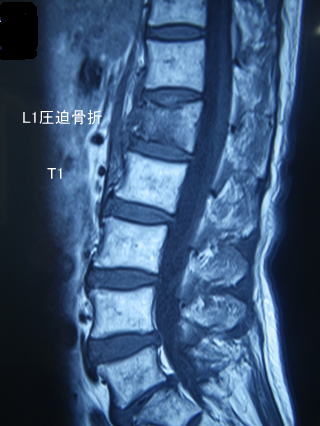 肋骨 骨折 リハビリ